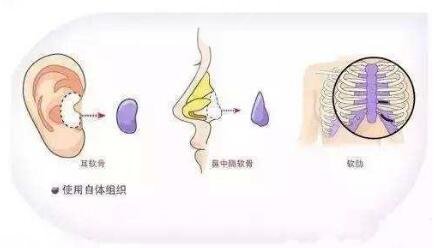 自體軟骨隆鼻缺點(diǎn)是什么？