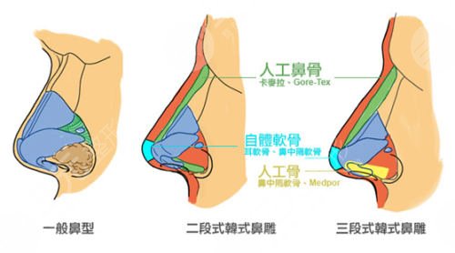 鼻翼縮小修復(fù)