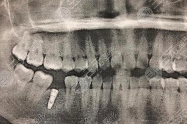 廈門市口腔醫(yī)院種植牙手術(shù)經(jīng)歷分享