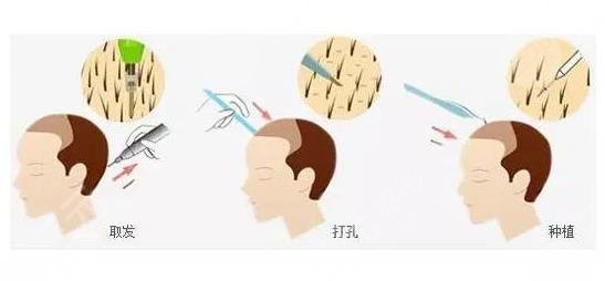 植發(fā)手術(shù)過程是怎樣的