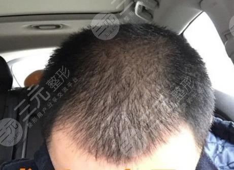 深圳流花醫(yī)院植發(fā)科植發(fā)經(jīng)歷分享