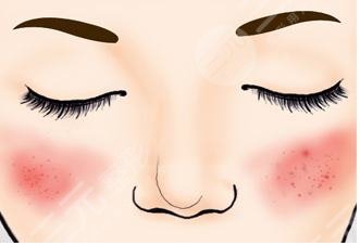 臉上紅血絲如何去除？怎么修復？