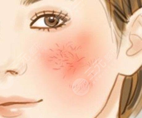 臉上紅血絲如何去除？怎么修復？