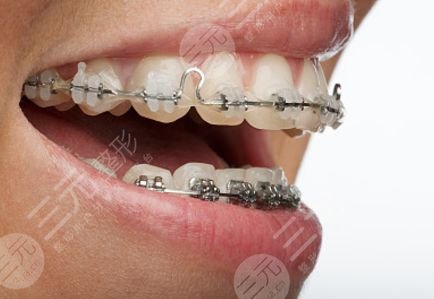 5類人不能做牙齒整形