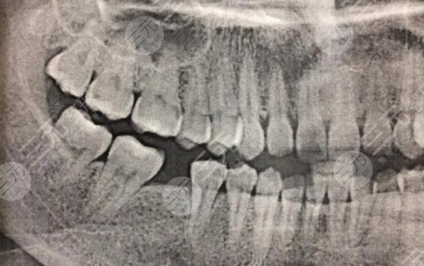 成都圣貝口腔醫(yī)院種植牙經(jīng)歷分享