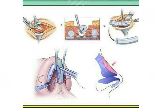 科普向：肋軟骨隆鼻可以維持多久？小白都關(guān)心的肋軟骨隆鼻那些事兒