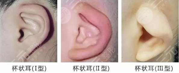 杯狀耳矯正器價格