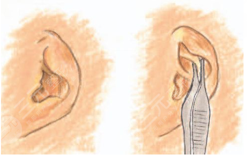 杯狀耳矯正器價格