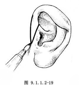杯狀耳矯正多少錢(qián)