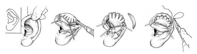 杯狀耳矯正多少錢(qián)