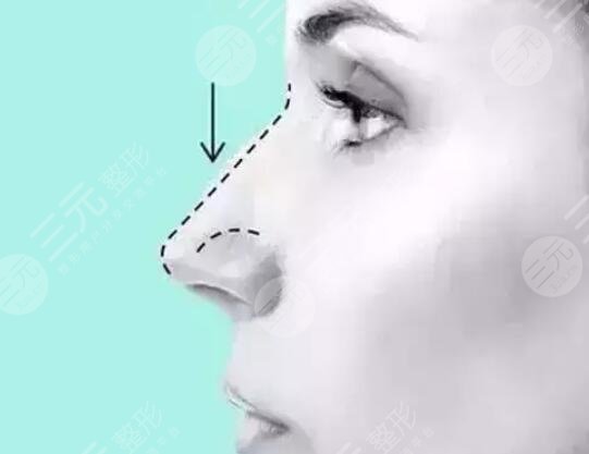 肋軟骨隆鼻術(shù)后注意事項(xiàng)