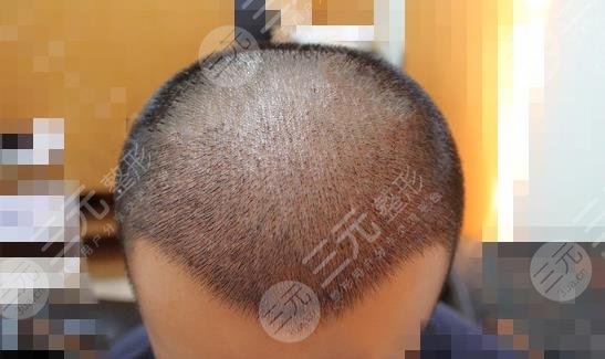 常州新生毛發(fā)醫(yī)院大面積脫發(fā)植發(fā)經(jīng)歷分享