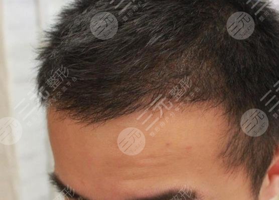 常州新生毛發(fā)醫(yī)院大面積脫發(fā)植發(fā)經(jīng)歷分享