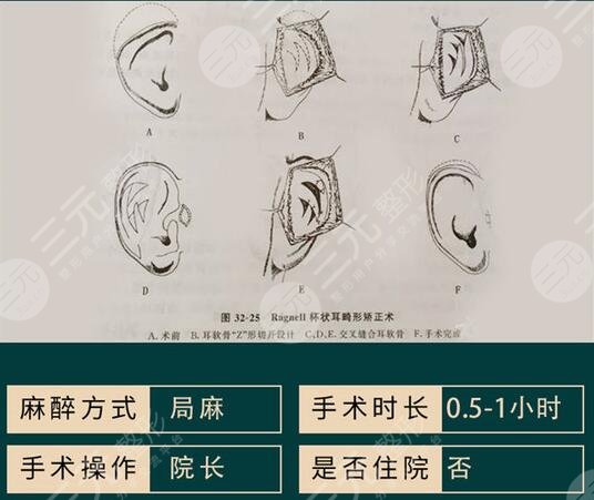 杯狀耳怎樣矯正