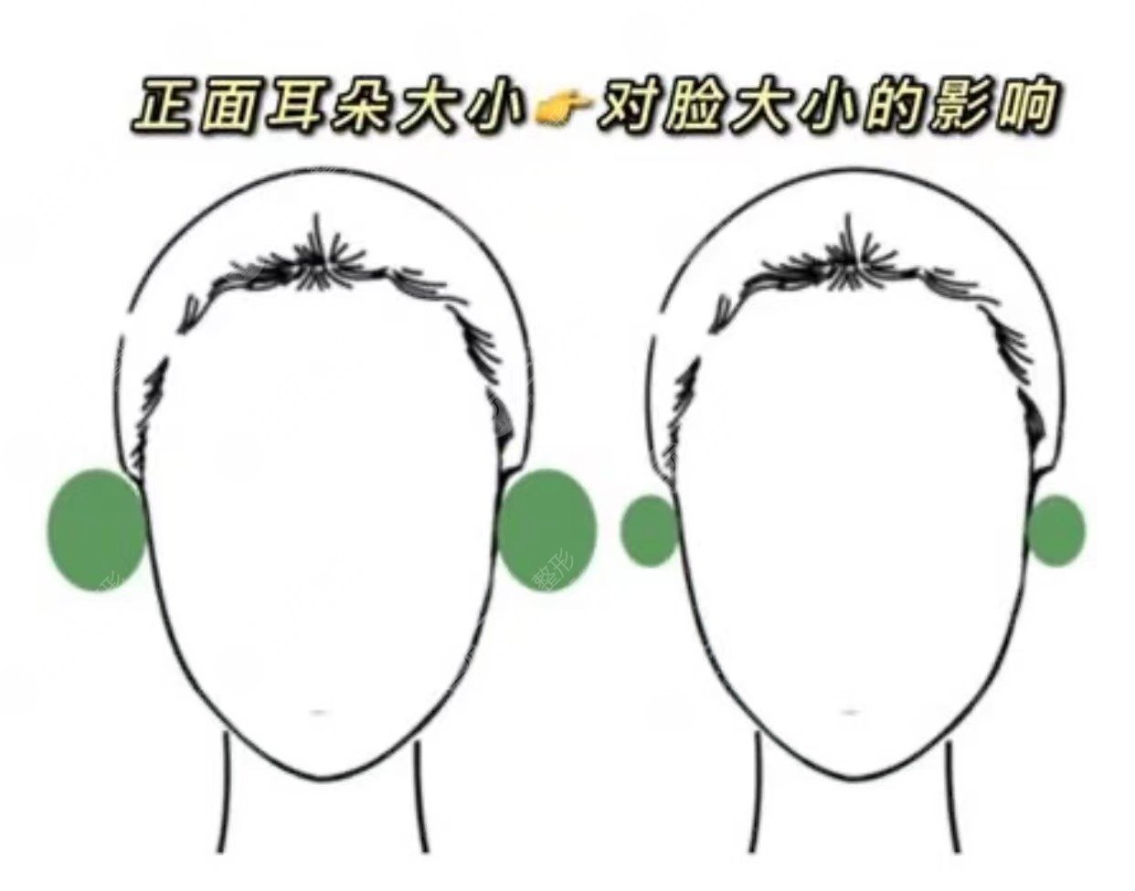 貼發(fā)耳矯正手術(shù)大概多少錢(qián)