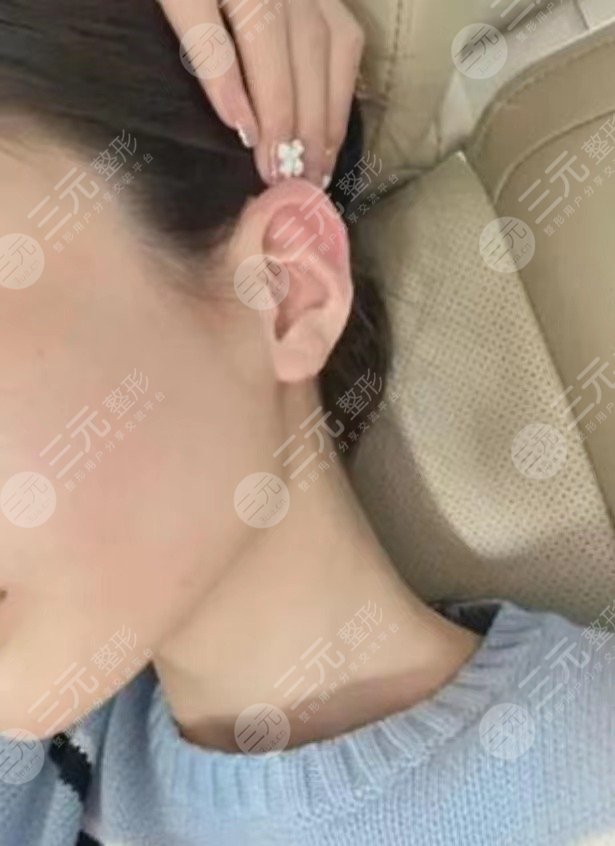 貼發(fā)耳矯正手術(shù)大概多少錢(qián)