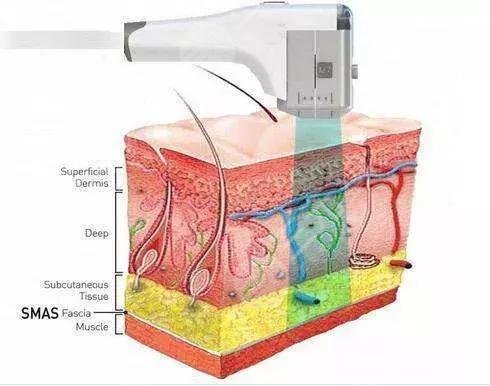 熱瑪吉可以去皺紋嗎