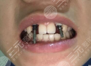 六安高峰口腔價格表