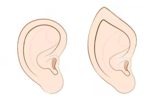 顱耳角在30°-60°之間朵怎么整形