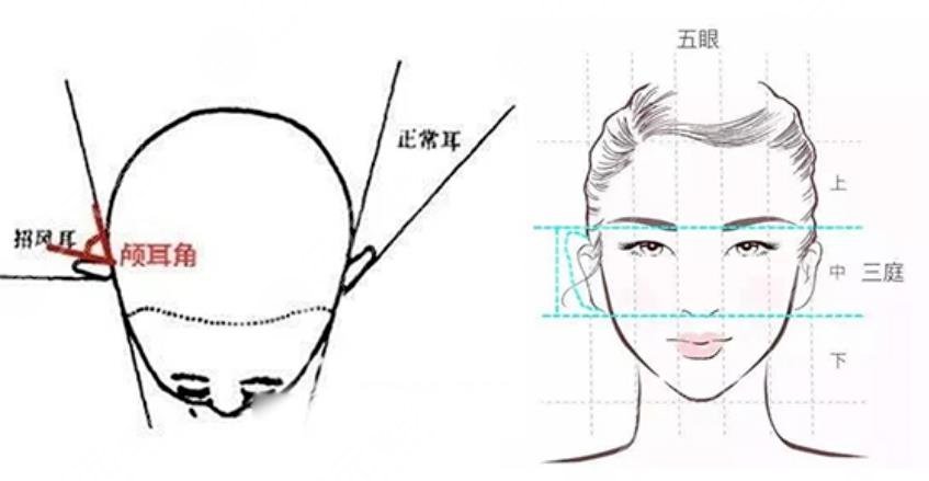 顱耳角在30°-60°之間朵怎么整形