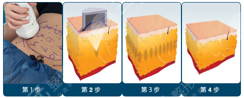 冷凍溶脂和抽脂哪個果好