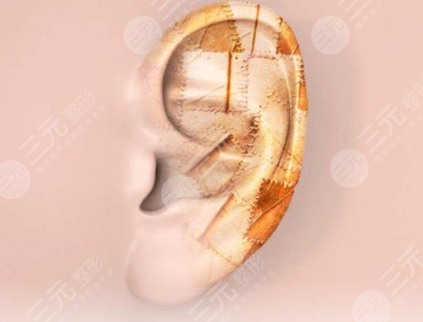 耳再造的方法盤(pán)點(diǎn)