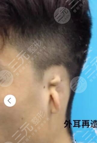 耳再造手術(shù)的注意事項(xiàng)