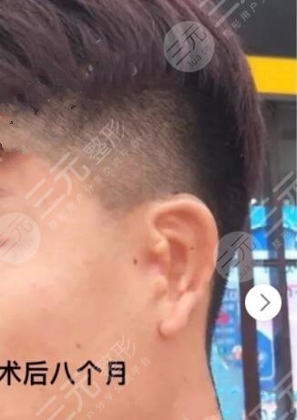 耳再造手術(shù)后