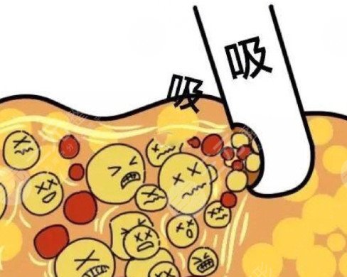 上海腰腹部抽脂減肥價格