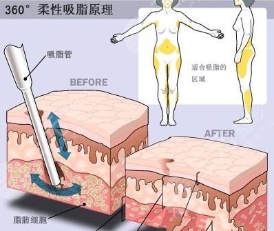 上海腰腹部抽脂減肥價格