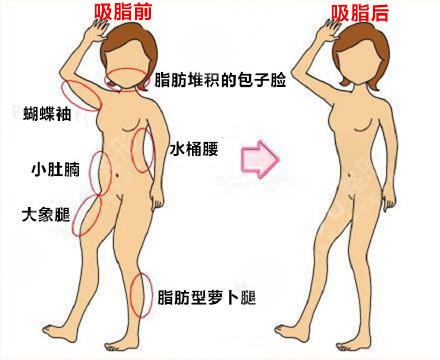 上海腰腹部抽脂減肥價格