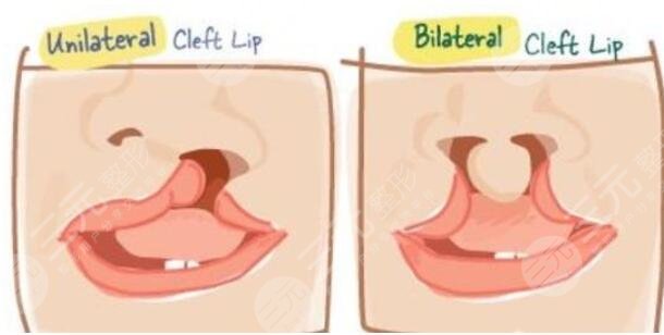 唇腭裂