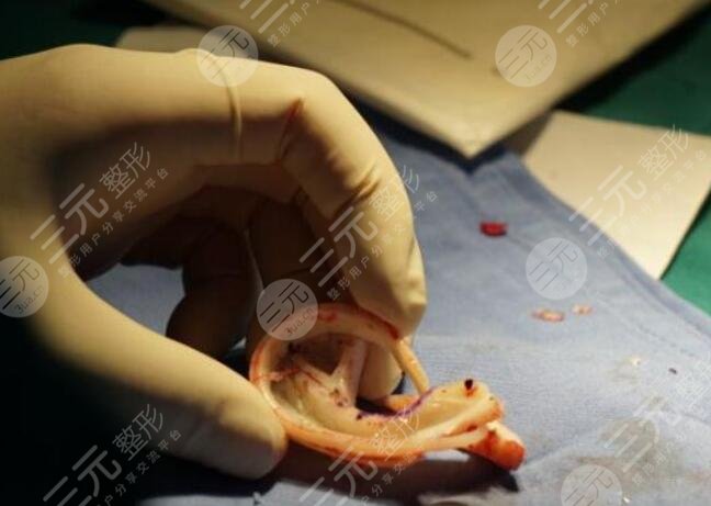 耳再造整形手術(shù)注意事項(xiàng)