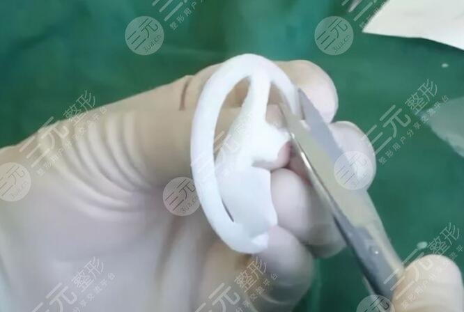 耳缺失再造手術(shù)技術(shù)成熟嗎