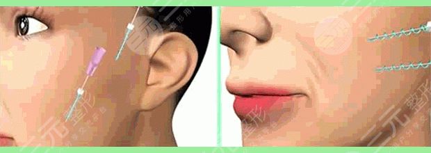 提升抗皺后多久可以做熱瑪吉