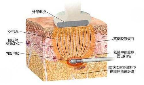 腰部塑形提高代謝做超脂塑溶脂