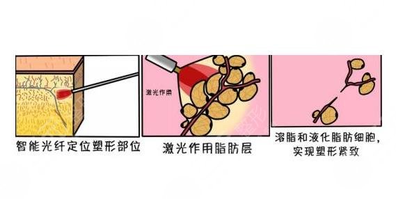 超脂塑溶脂怎么樣?