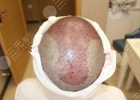合肥新生植發(fā)醫(yī)院大面積植發(fā)案例分享