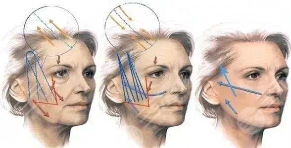 面部抗衰抗皺知識(shí)科普