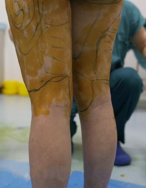 國內(nèi)吸脂醫(yī)院：北京禾美嘉大腿吸脂案例