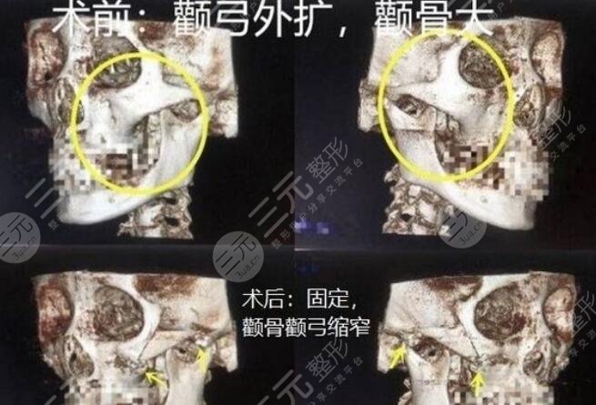 磨骨手術(shù)的成好嗎