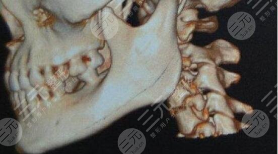 做磨骨手術(shù)的注意事項(xiàng)須知