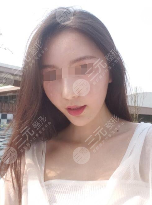 3d射頻緊膚去皺后1個(gè)月