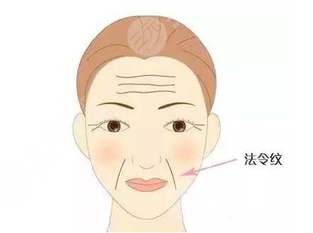 有法令紋怎么辦？去法令紋價格大概多少錢？附價格表