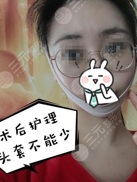 沈陽百嘉麗醫(yī)療美容醫(yī)院面部射頻溶脂案例分享：手術(shù)之后