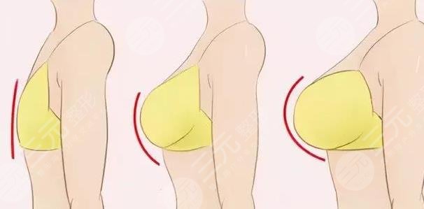 上海隆胸手術(shù)相關(guān)介紹