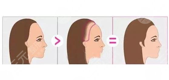 沈陽華美植發(fā)醫(yī)院發(fā)際線種植相關(guān)介紹