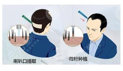 蘭州植發(fā)醫(yī)院發(fā)際線種植相關(guān)問題介紹