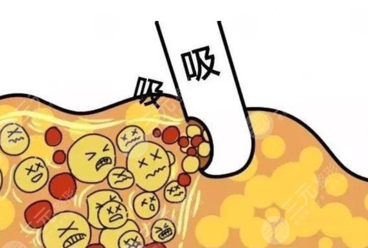 瘦身欄目|超脂塑吸脂有沒(méi)有副作用？來(lái)看看哪些人不適合做！