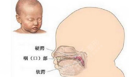 唇腭裂修復(fù)手術(shù)大概需要多少費(fèi)用？?jī)r(jià)格主要看這幾點(diǎn)...